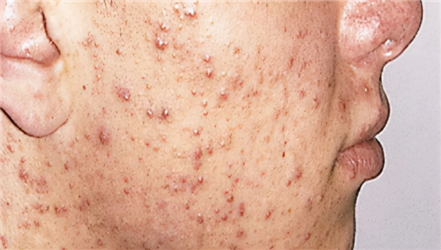 很多人在熬夜吃火锅,月经前会出现这种炎症性的痘痘.