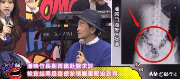 女性身体不适就医 X光显示“顶到胃”女神形象破灭，粉丝：真恶心