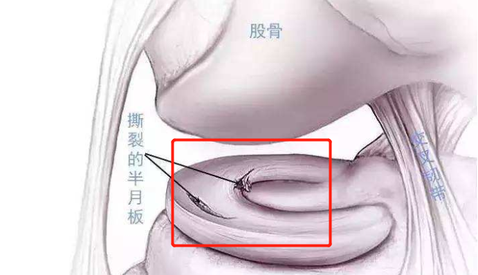 膝盖总是响，可能是4个地方“病”了！怎么治疗？医生一次说清楚