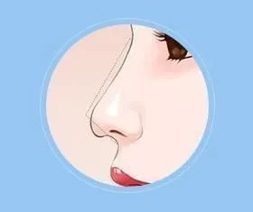 箭头鼻与鹰钩鼻有哪些区别？