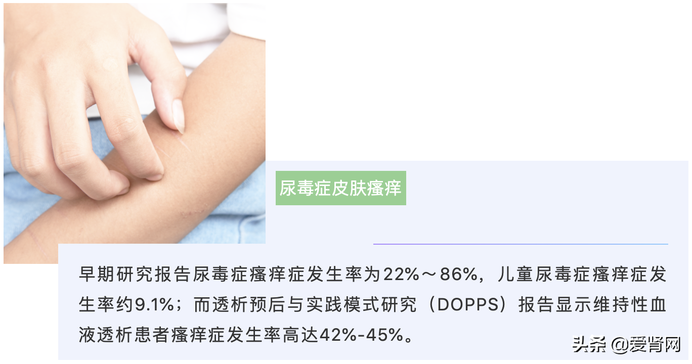 肾友缓解皮肤瘙痒最全方案，真的不要错过本文
