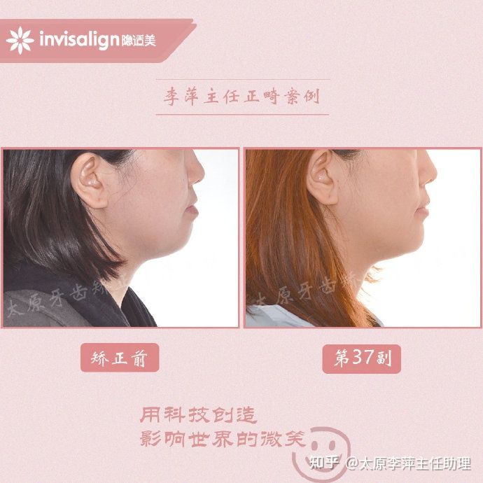 太原牙齿矫正：隐形牙套效果好不好？看这些病例你就知道了