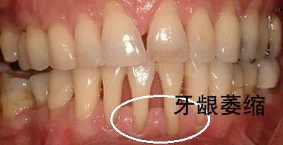 牙龈萎缩怎么办？科学应对与有效治疗方法