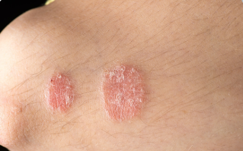 关节癣图片(银屑病斑块状是最严重的吗) - 赤虎壹号