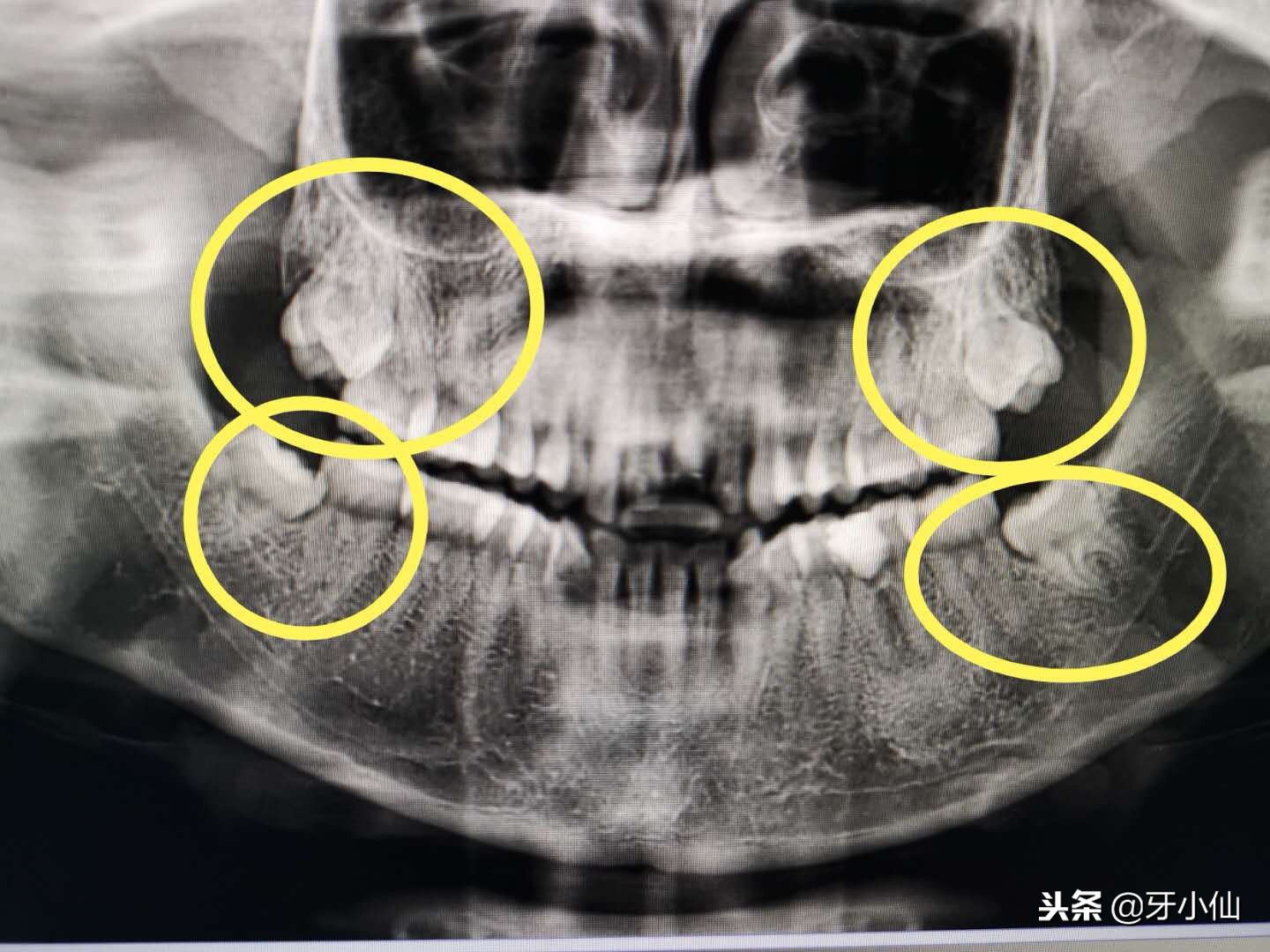 拔牙痛不痛？拔牙要多久？你关心问题的答案都在这里哦~