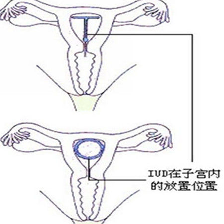 一般上环需要多少钱一文说清楚