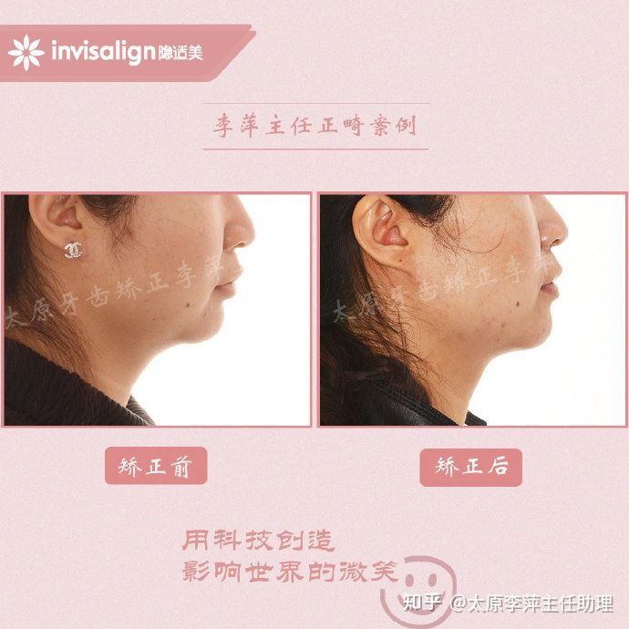 太原牙齿矫正：隐形牙套效果好不好？看这些病例你就知道了