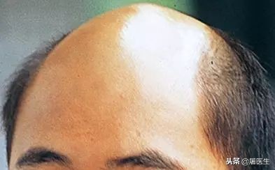 中年男性秃顶的原因及预防，附 秃顶的十大好处和秃顶歌