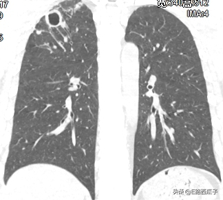 一种不容被忽视的传染病—肺结核