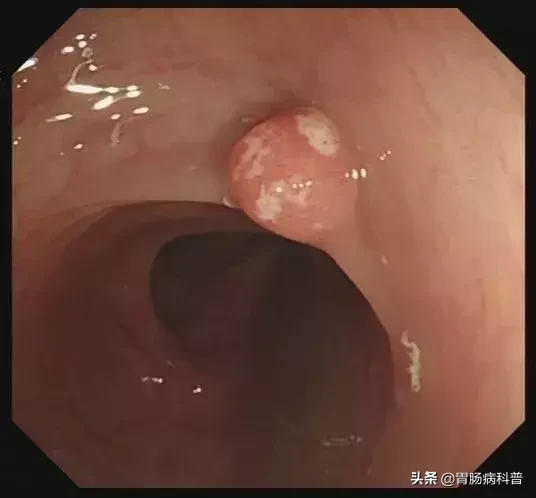 医生是怎样切掉肠息肉的?