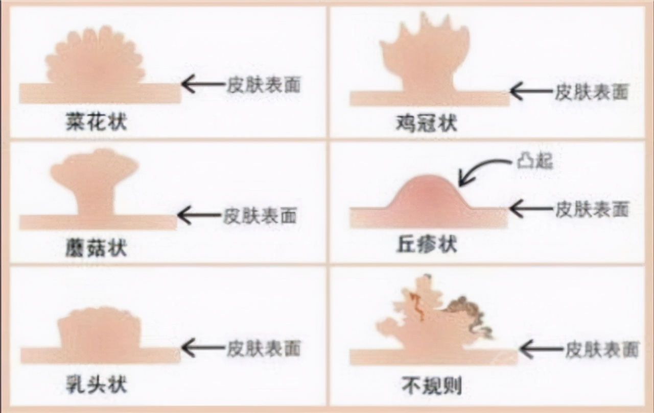 肛门长了个"小肉球",是痔疮还是尖锐湿疣?教你怎么区分