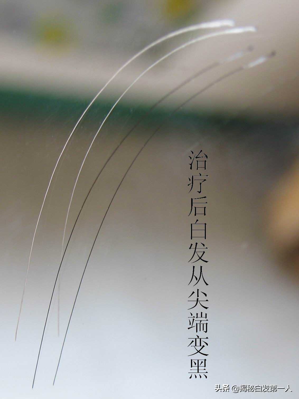 腔隙性脑梗塞与腔隙性脑梗死