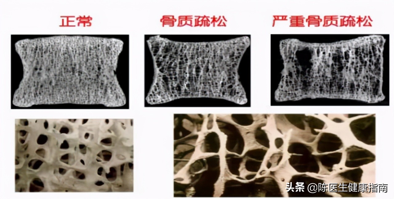 维生素D3、骨化三醇、阿尔法骨化醇，区别在哪里？到底该怎么选？