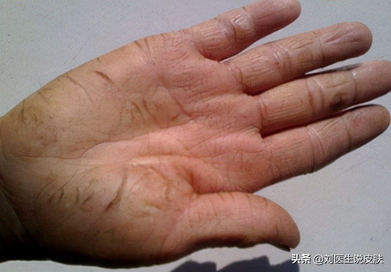 手脚皲裂有救了！教你「白+黑」护理方法，重现柔嫩肌肤