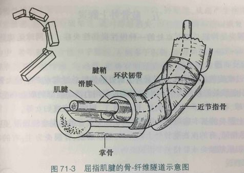 医生提醒：手上出现这2个变化，十有八九是腱鞘炎，快对照看看