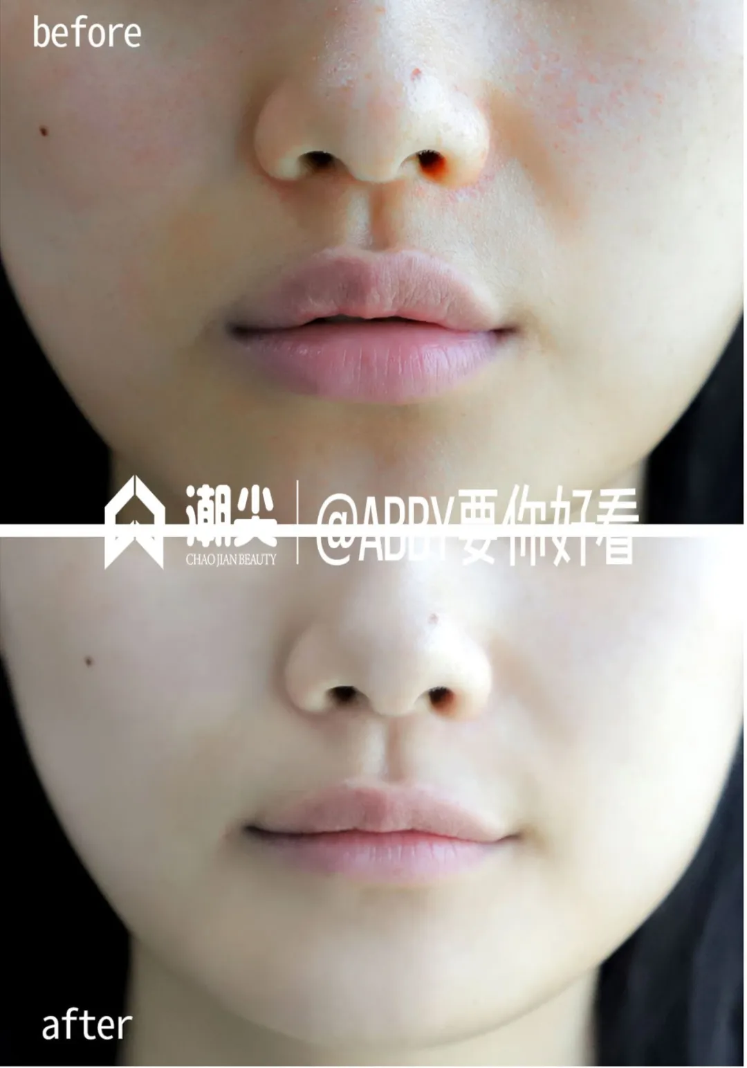 荣晟医用冷敷贴效果怎么样,好用吗