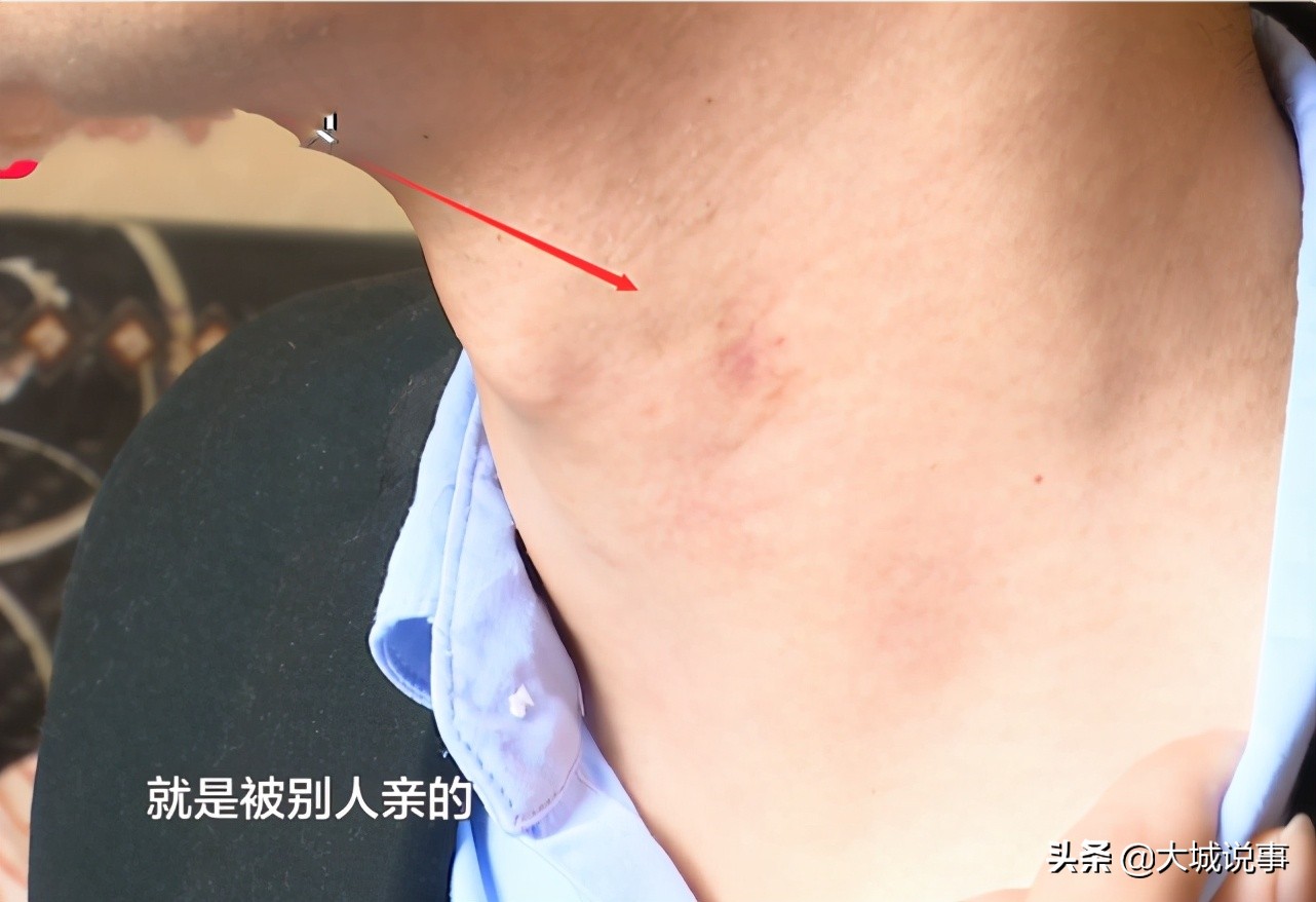 醒来多个“草莓印”，三年感情差点凉凉，男子上医院证清白