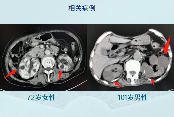 多囊腎,腎臟不好的更容易長癌,要學會3個排毒小方法