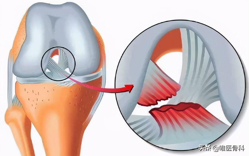 大腿内侧疼痛是什么原因引起的(膝盖疼) - 百百科