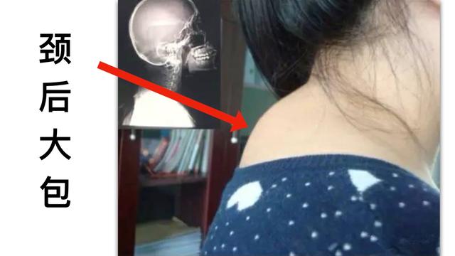 富贵包形成原因及消除方法：脖子后方凸起如何改善