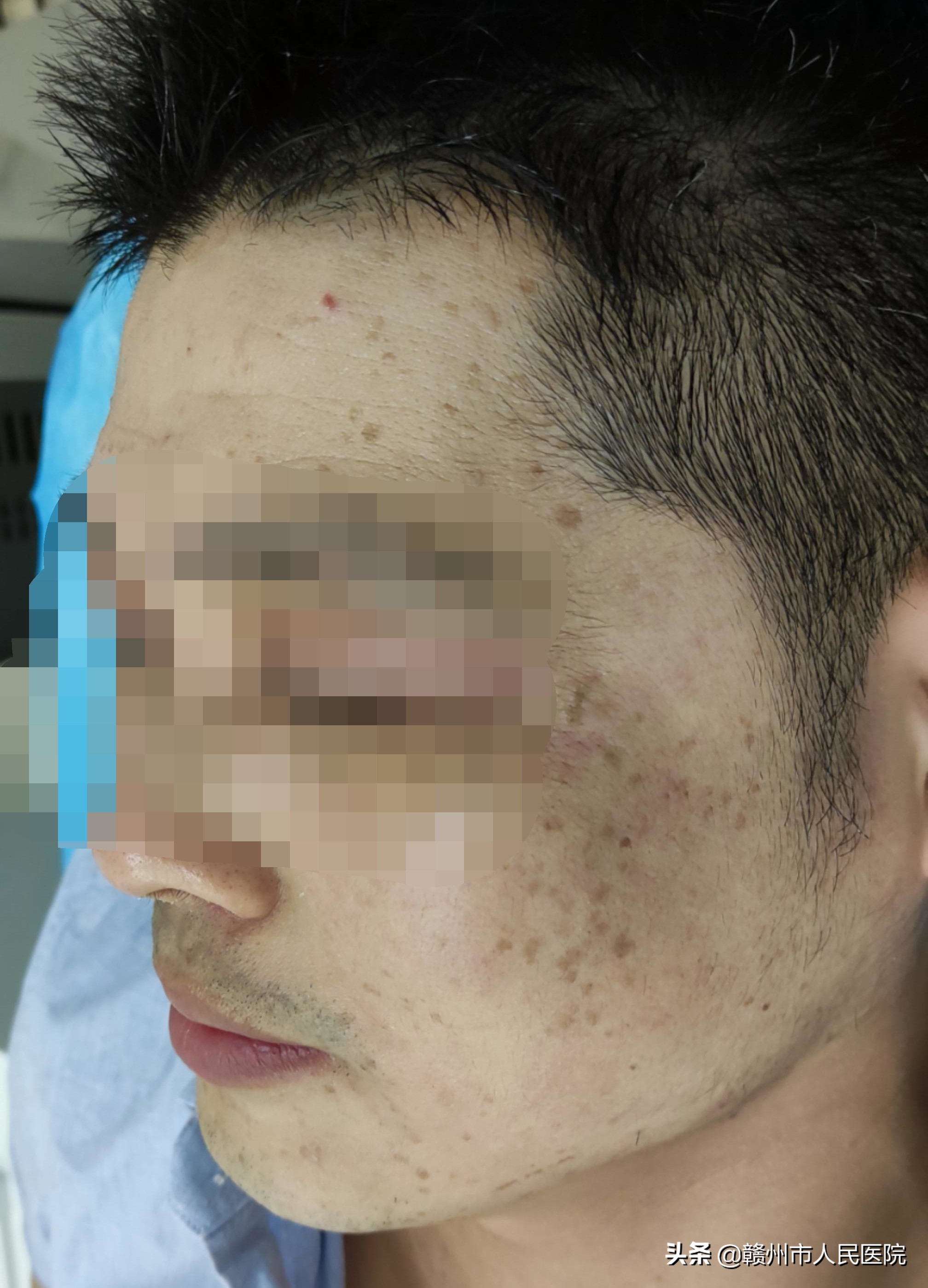 科普:身上长了"小疙瘩",还越挠越多,都是hpv惹的祸!