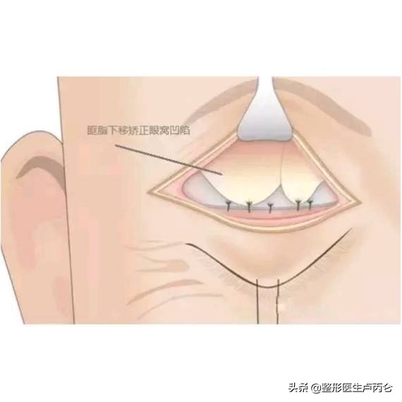 如果眼部整形做得不满意还可以修复吗？眼窝凹陷怎么办？