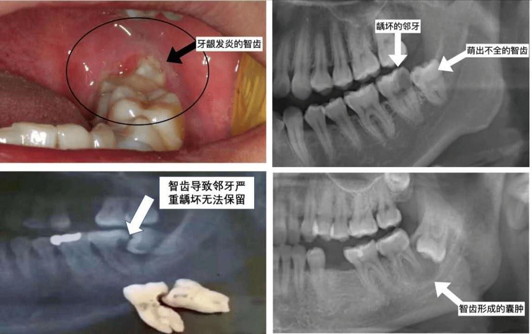 智齿拔不拔，疼不疼，拔牙费用，拔牙后影响，一次性说清楚