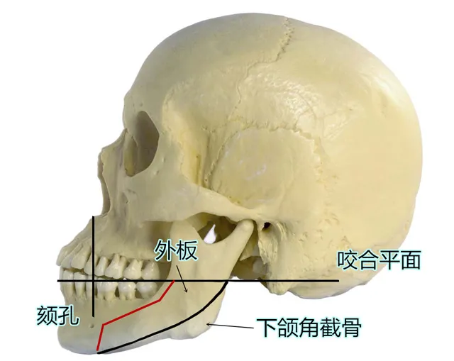 下颌角改善需要注意哪些方面