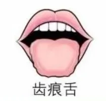 26岁男子发烧九天不退，中药方仅仅添加了荆芥、薄荷，立马退烧