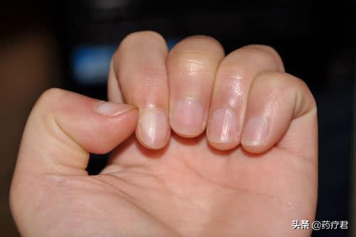 正常指甲月牙图片(指甲上的月牙) - 赤虎壹号