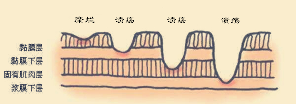 胃里面有了糜烂是不是很严重？吃药一直不好原来是吃错了药