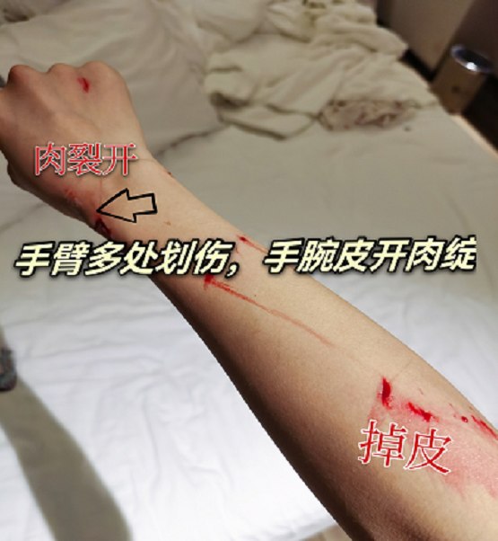 30岁女星意外受伤！洗澡时玻璃门突然爆炸，手腕皮开肉绽伤口可怖