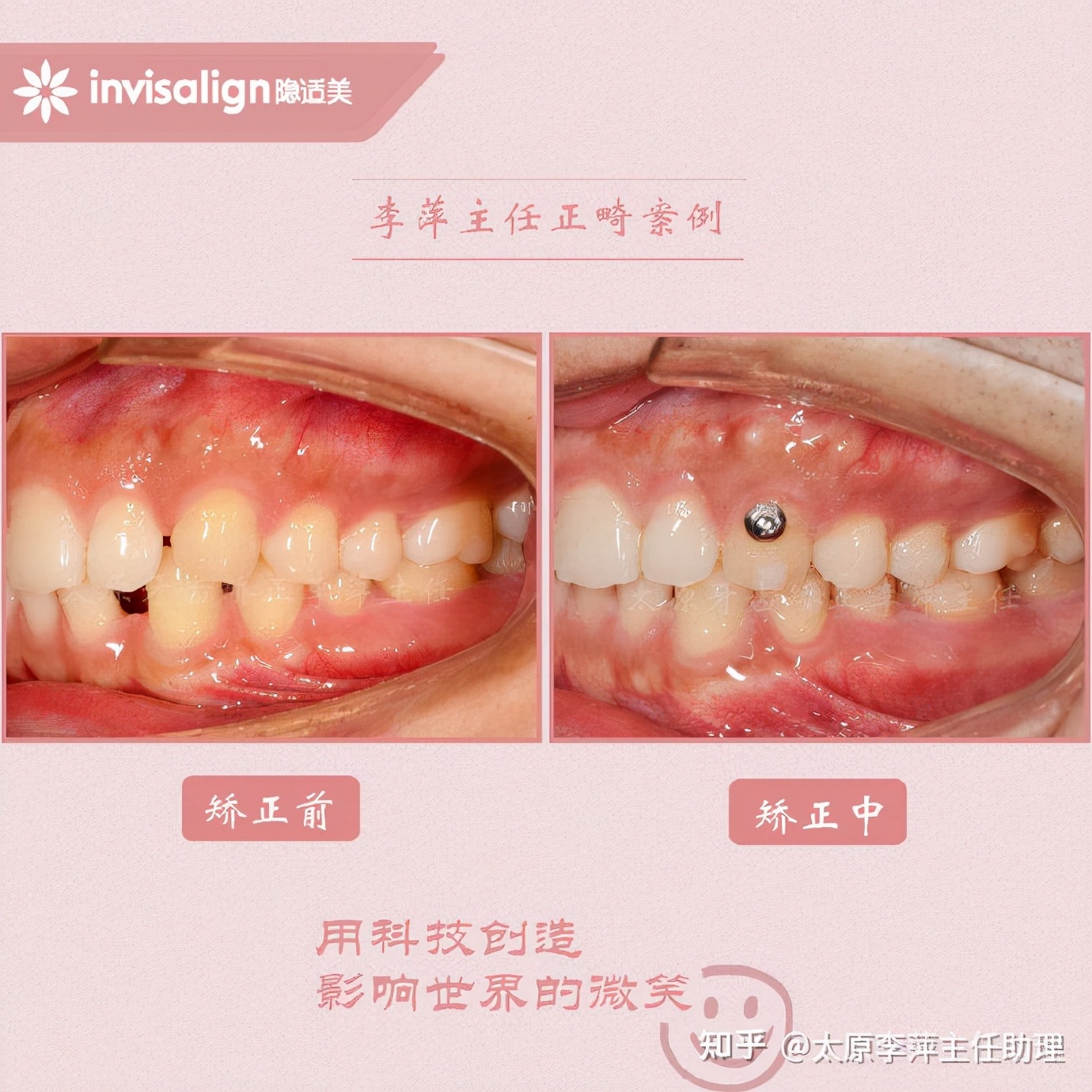 太原牙齿矫正：隐形牙套效果好不好？看这些病例你就知道了