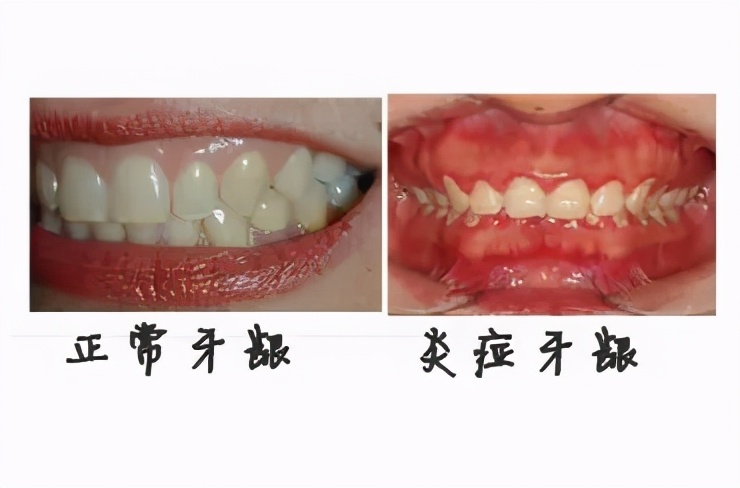 牙龈长脓包自己戳破？这样做很危险