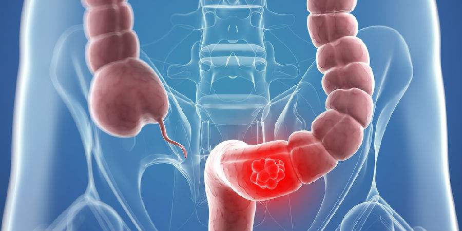 出现左下腹疼痛别大意，常见病因有4种！医生告诉您该怎么办