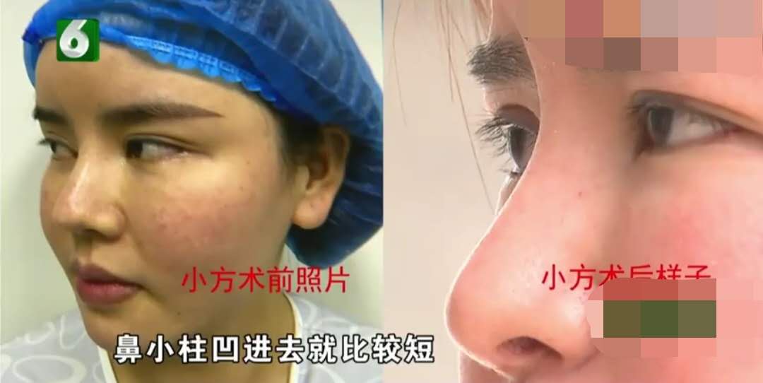 女子花4万5做鼻子微整，做完后看到自己就很烦：我不是来毁容的