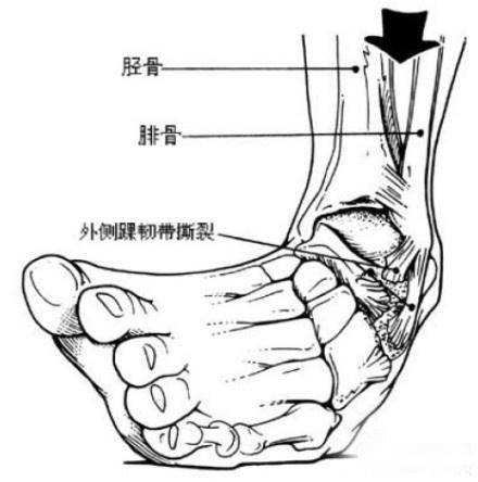 崴脚后只拍X光片就可以吗？医生：这种情况不治疗将会一直崴脚