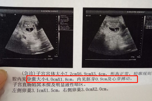 怀孕5-8周，从“小海马”到胎儿变化大，4点特别注意孕妈牢记