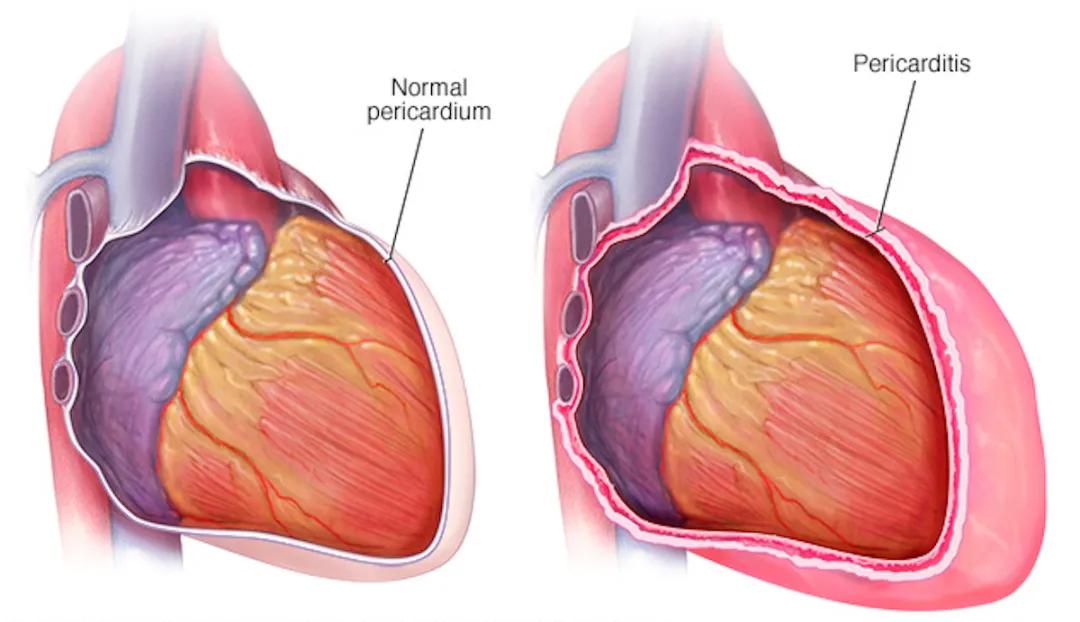 胸部痛疼是什么原因？引起胸痛常见的12种原因 9