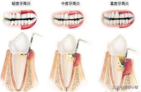 牙齿松动怎么办？别急！这几种方法来解救你