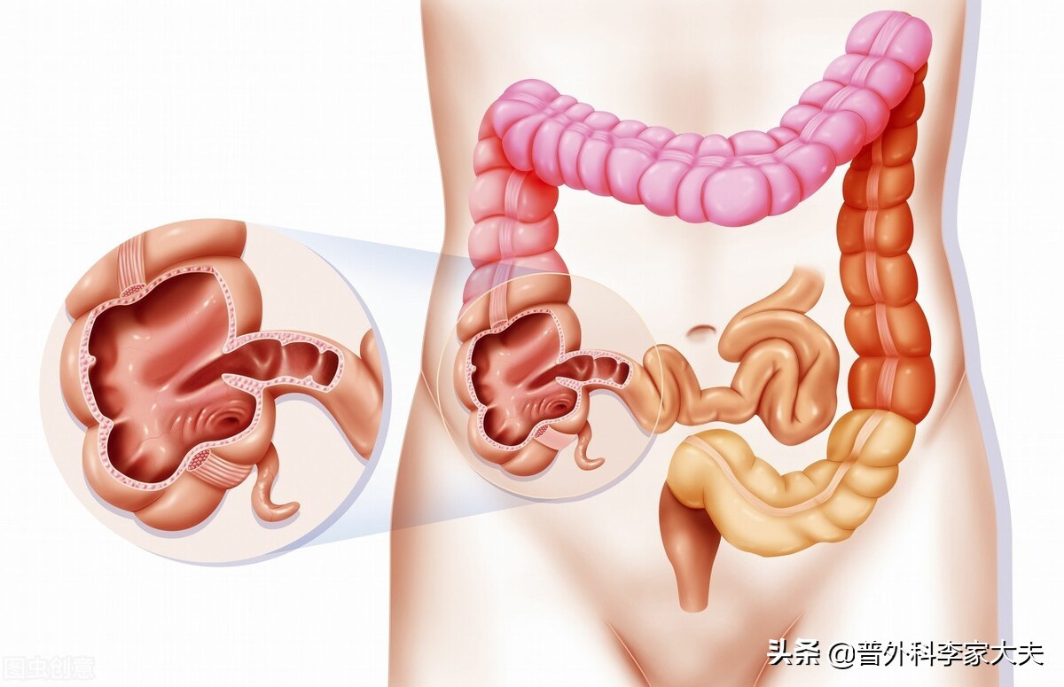 内侧通过回盲瓣与回肠相连,上延续为升结肠,盲肠为结肠管径最大的部位