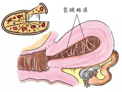 生化流产是什么意思(生化妊娠是什么) - 百百科