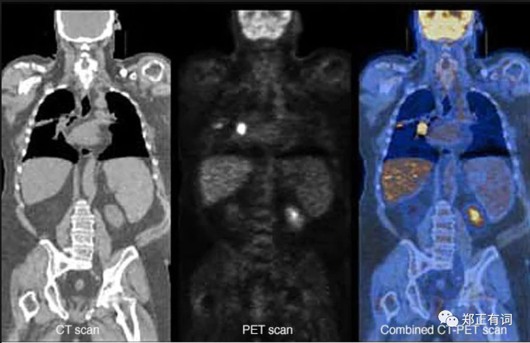 针对恶性肿瘤的最尖端、最先进、最准确的影像学评估手段—PET/CT，做一次9000块？还不报销！