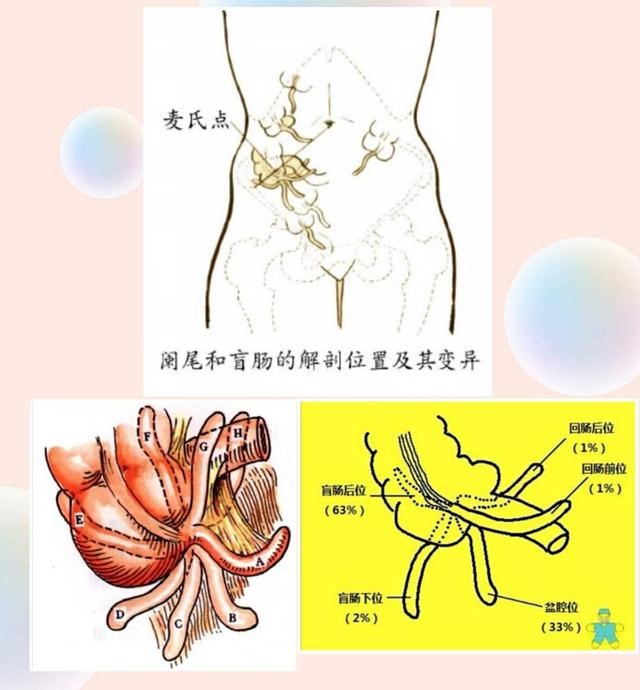 腹腔镜阑尾炎孔位置图图片