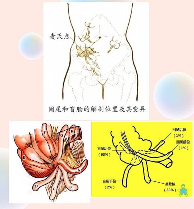 急性阑尾炎一定要手术吗?选择开刀？还是腹腔镜手术?