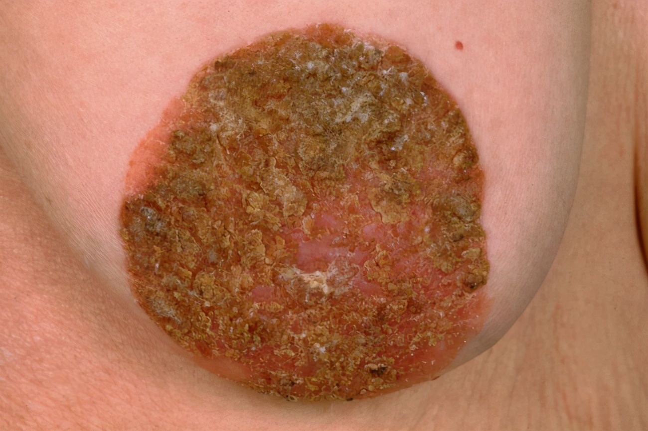 人类乳头瘤感染图片