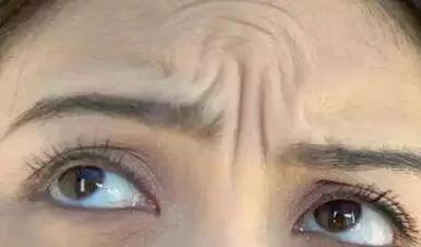 让日本女人夜夜疯狂的神器，法令纹、眉间纹克星！一贴＝10次除皱