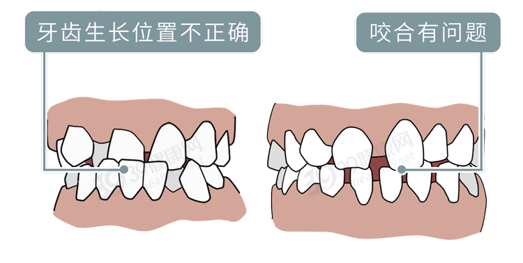为什么只要戴牙套，牙齿就可以恢复得很整齐？生动展示矫正过程