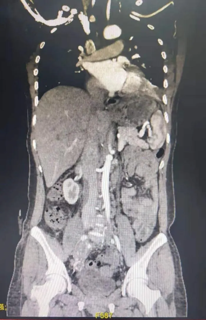 “小腿般”的肿瘤竟“藏”胸中！“MDT”为手术保驾护航