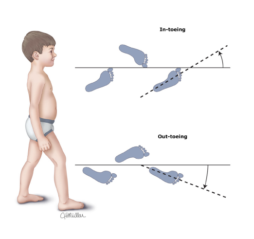 小孩走路内八字，需要担心么？